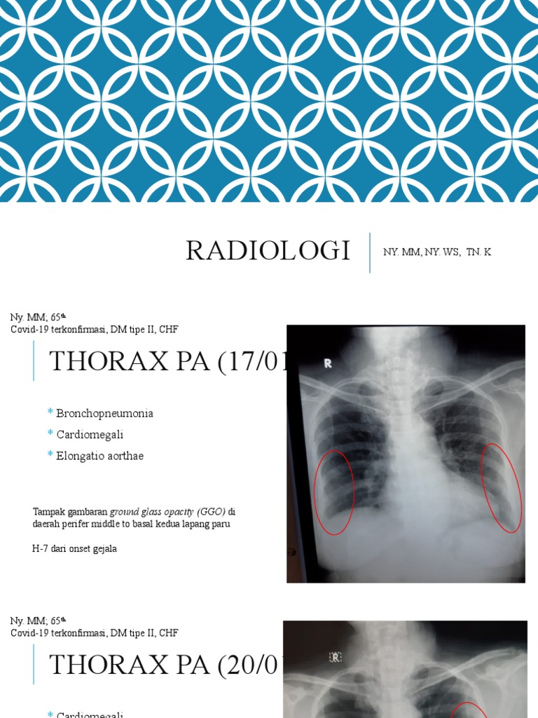 Diagnosa Cardiomegali dan COVID-19 pada CXR | PDF | Kesehatan Holistik
