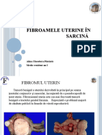 Fibroamele uterine În sarcinĂ