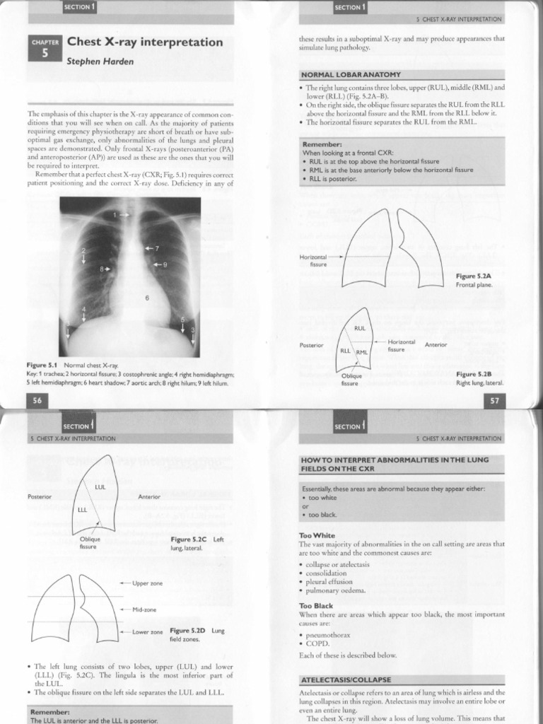 Chest X-Ray Interpretation Guide | PDF | Lung | Animal Anatomy