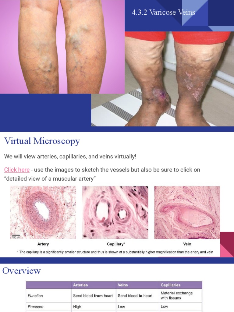 Virtual Microscopy of Varicose Veins | PDF