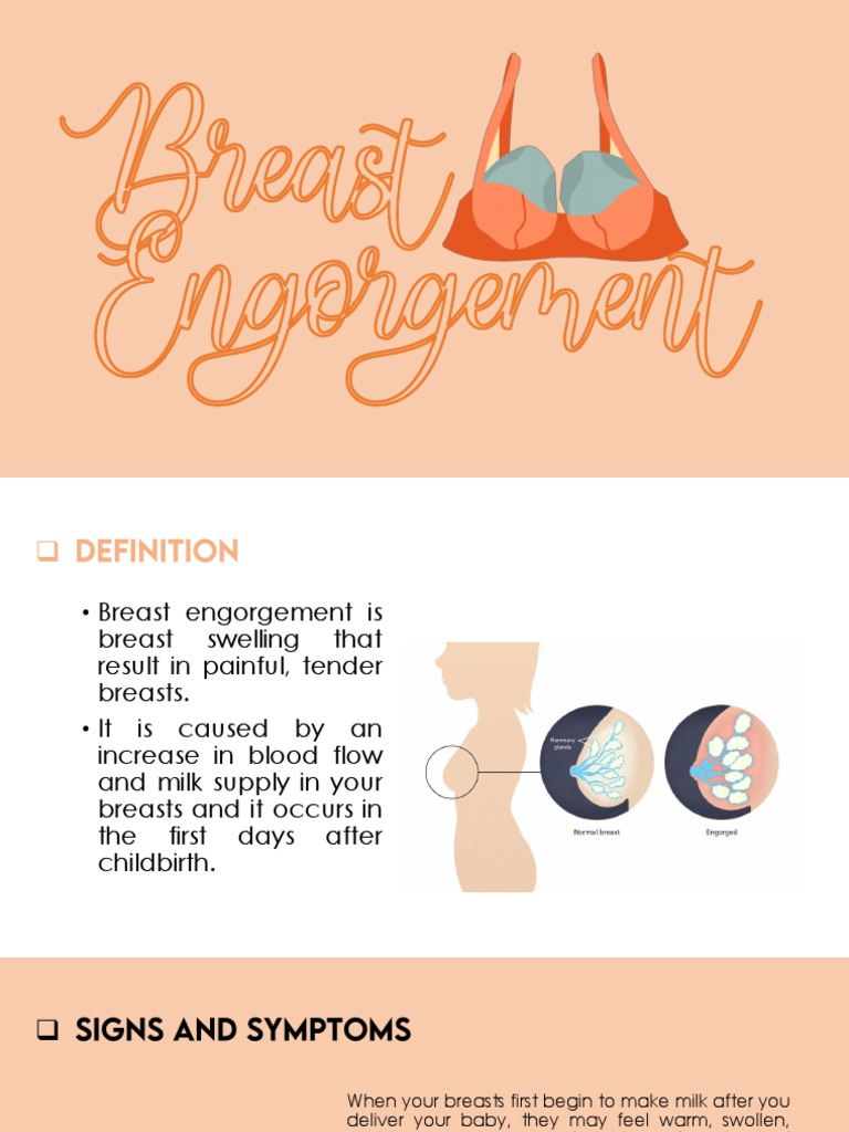 Understanding Breast Engorgement | PDF | Breastfeeding | Breast Milk