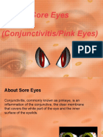 Sore Eyes (Conjunctivitis/Pink Eyes)