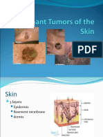 Malignant Tumors of The Skin