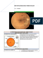 Alteraciones Patológicas Del Fondo Ocular