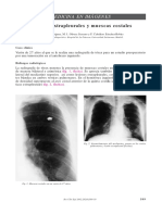 Lesionesextrapleuralesymuescascostales: Medicin A en Imá Gen Es