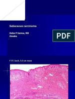 Sebaceous Carcinoma.