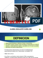 tuberculoma-160831011543