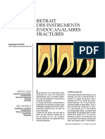 Retrait Des Instruments Endocanalaires Fracturés