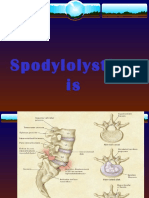 Spodylolysthes Is
