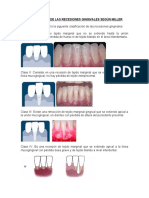 Reseciones Gingivales de Miller