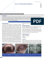 Oral Manifestations of Hypothyroidism: A Case Report: Abst T