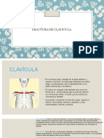 Fractura de Clavicula