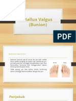 Hallux Valgus