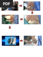 Drug Study - Epidural Anesthesia