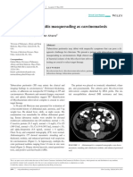 Tuberculous Peritonitis Masquerading As Carcinomatosis