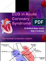 ECG in Acute Coronary Syndrome: DR Awadhesh Kumar Sharma Deptt of Cardiology