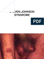 Steven-Johnson Syndrome