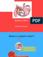 Gastric Ulcer: Jehieli Villarreal