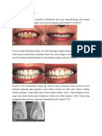 Teknik Veneer