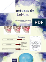 Fracturas de Lefort