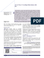 Orthodontic Management of Class I Crowding Malocclusion With Palatal Canine Impaction