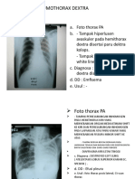 Pneumothorax Dextra