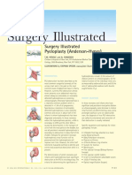 Pyeloplasty (Anderson-Hynes)