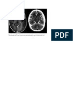 Gambaran MRI Dari Empiema Subdural Pada Parietal Sebelah Kiri