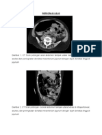 Perforasi Usus