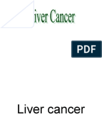 14558715-Liver-Cancer