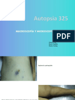 Autopsia 325 Adenocarcinoma Pulmon