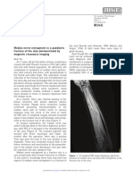 Median Nerve Entrapment in A Paediatric Fracture of The Ulna Demonstrated by Magnetic Resonance Imaging
