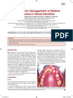 Orthodontic Management of Midline Diastema in Mixed Dentition