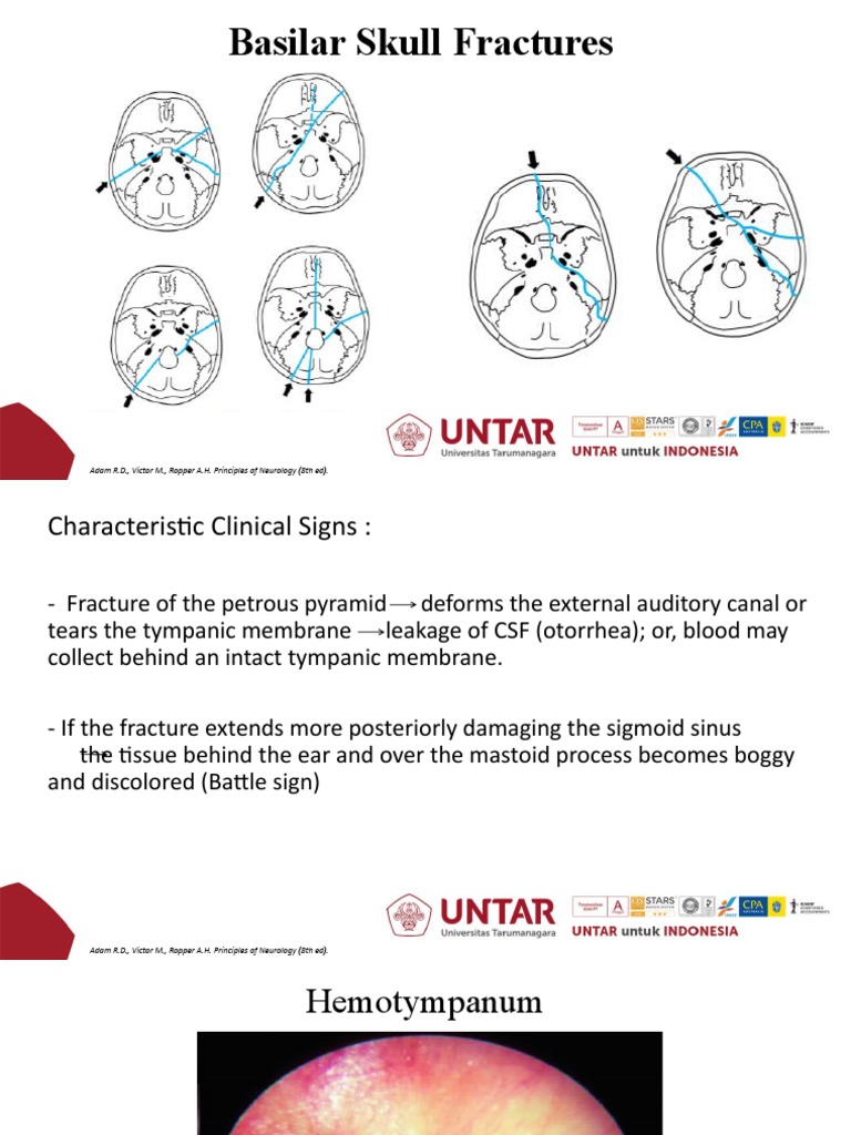 Clinical Presentation, Diagnosis, and Treatment of Basilar Skull Fractures PDF Traumatic