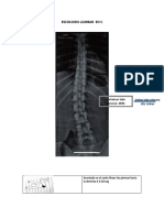 Escoliosis - C