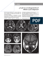 Anomalías de Fosa Posterior, Hemangioma