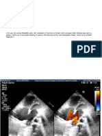 Atrial Septal Defect