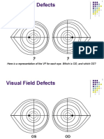 Here Is A Representation of The VF For Each Eye. Which Is OD, and Which OS?