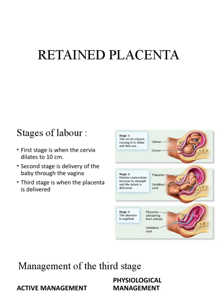 Retained Placenta | PDF | Placenta | Uterus
