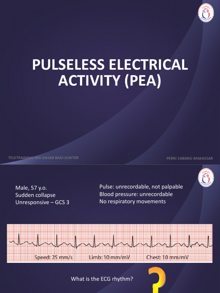 EKG pada Pulseless Electrical Activity | PDF