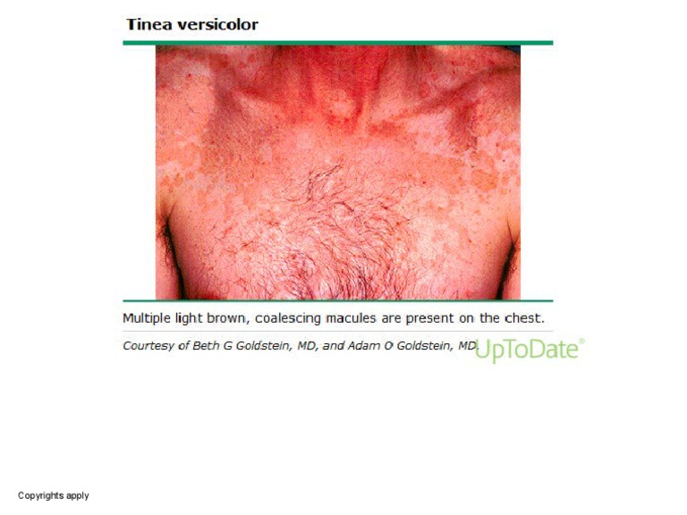 Tinea Versicolor Chest PDF