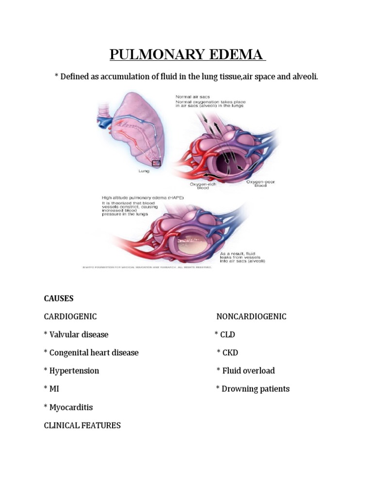 Understanding Pulmonary Edema Causes & Treatment | PDF