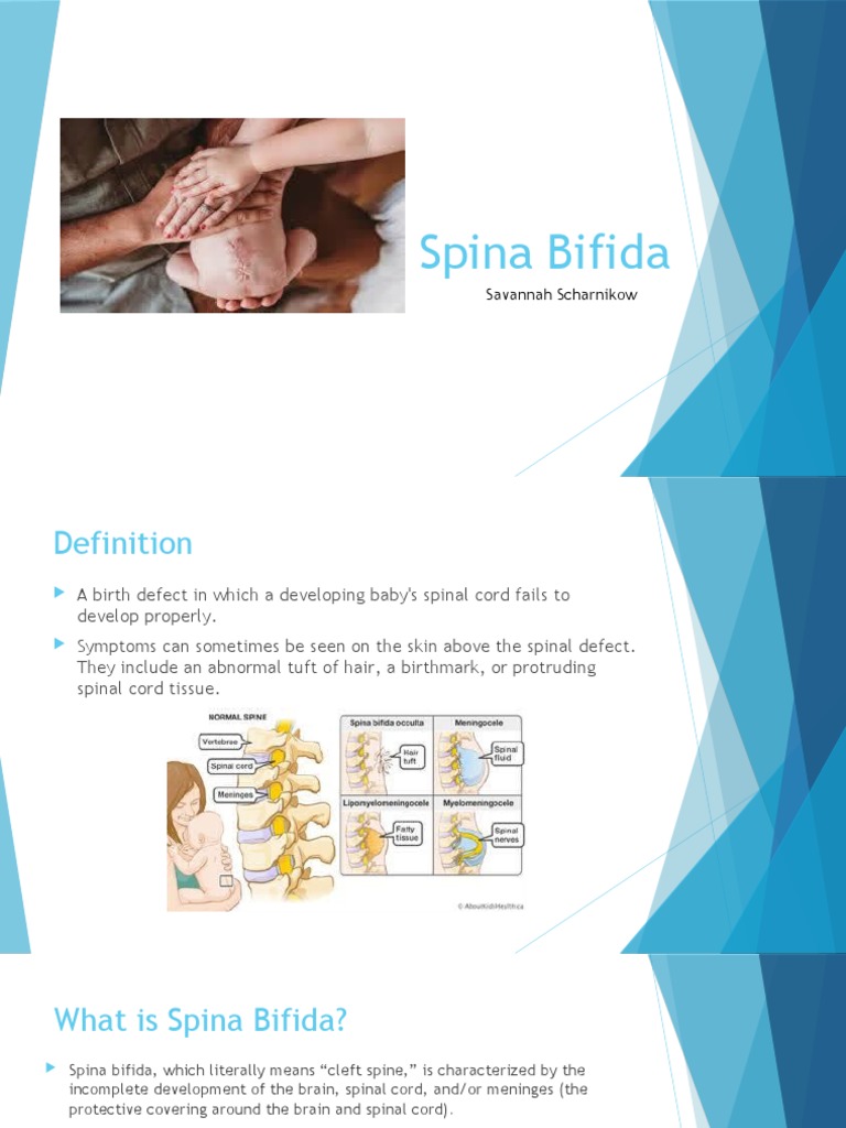Spina Bifida Powerpoint PDF