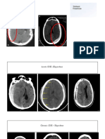 Subdural Hematoma