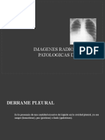 Derrame Pleural y Neumotórax