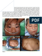 Measles Pneumonia Case Study