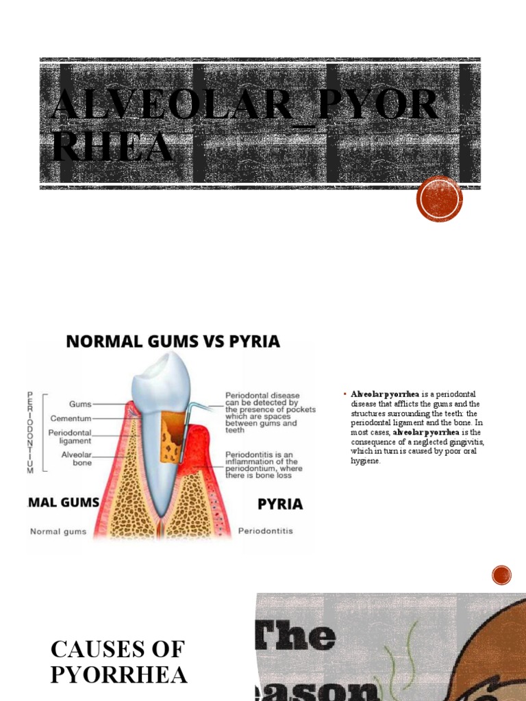 Understanding Alveolar Pyorrhea Causes | PDF