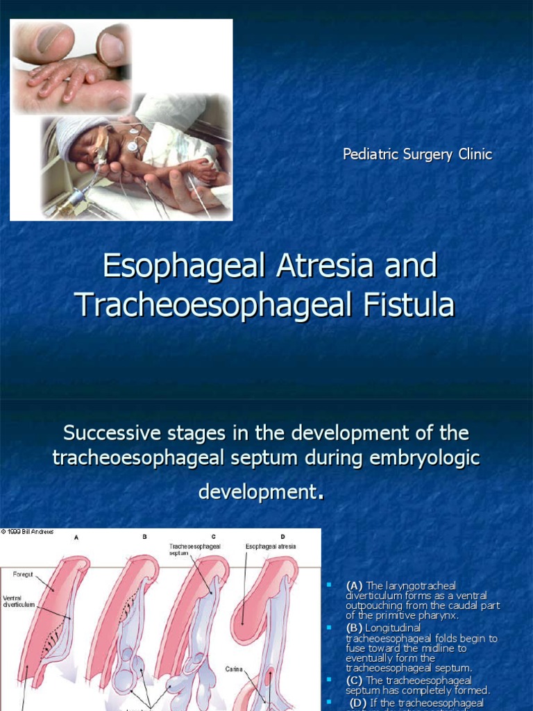 Esophageal Atresia And Tracheoesophageal Fistula Pdf Esophagus