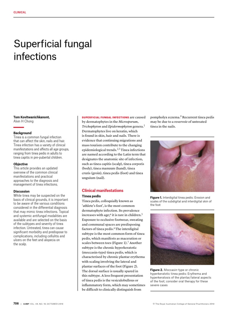 Superficial Fungal Infections (2019) | PDF | Psoriasis | Dermatology