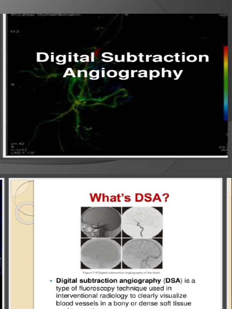 Dsa PDF Interventional Radiology Radiology
